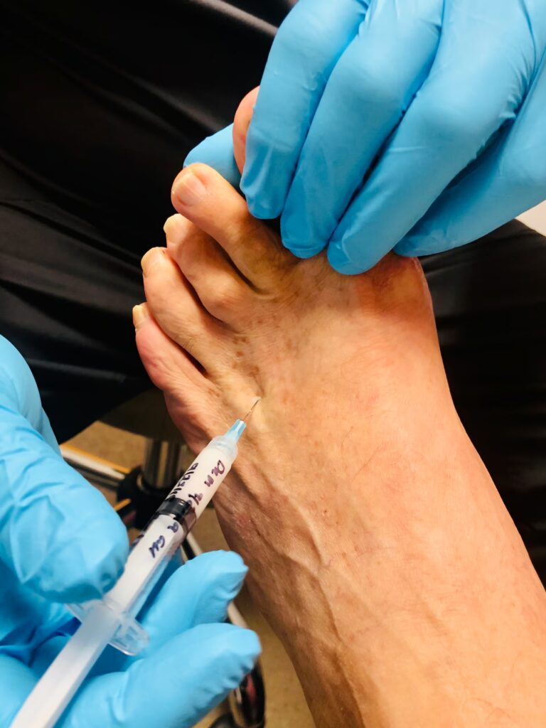 patient getting a steroid injection in his foot 2024 12 05 07 55 39 utc