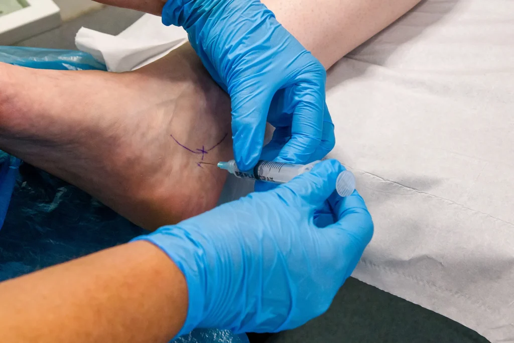 Ankle block for Verruca needling