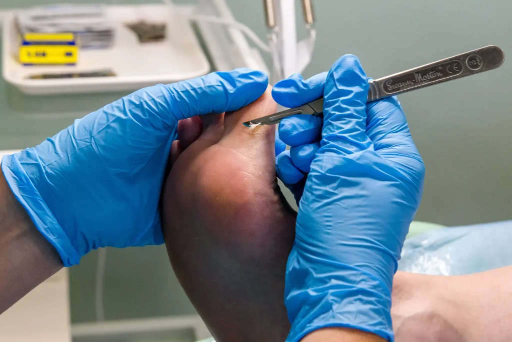 Callus reduction 3